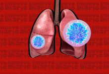 Photo of Atención tardía de cáncer de pulmón eleva muertes y costos en Latinoamérica